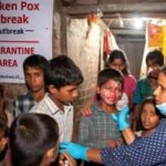 धनबाद में चिकन पॉक्स का प्रकोप, 10 मामलों की पुष्टि, जागरूकता अभियान तेज…