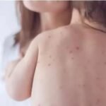 धनबाद में बढ़ रहे चिकन पॉक्स के मामले, 200 से ज्यादा संक्रमित…