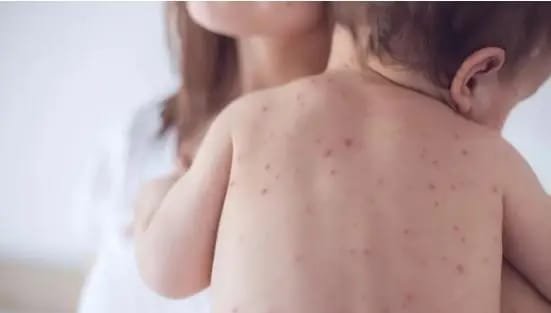 धनबाद में बढ़ रहे चिकन पॉक्स के मामले, 200 से ज्यादा संक्रमित…