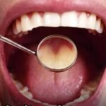 देश में हर साल बढ़ रहे Oral Cancer के मामले, डॉक्टर बोले- 70% मरीजों को इलाज मिलने में होती है देर…