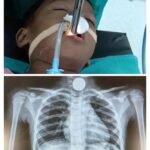 06 वर्षीय नन्ही बच्ची के लिये वरदान बना “SJAS सुपरस्पेशियलिटी हॉस्पिटल” 15 दिन में तीसरी बार बचायी नन्ही बच्ची की जान….