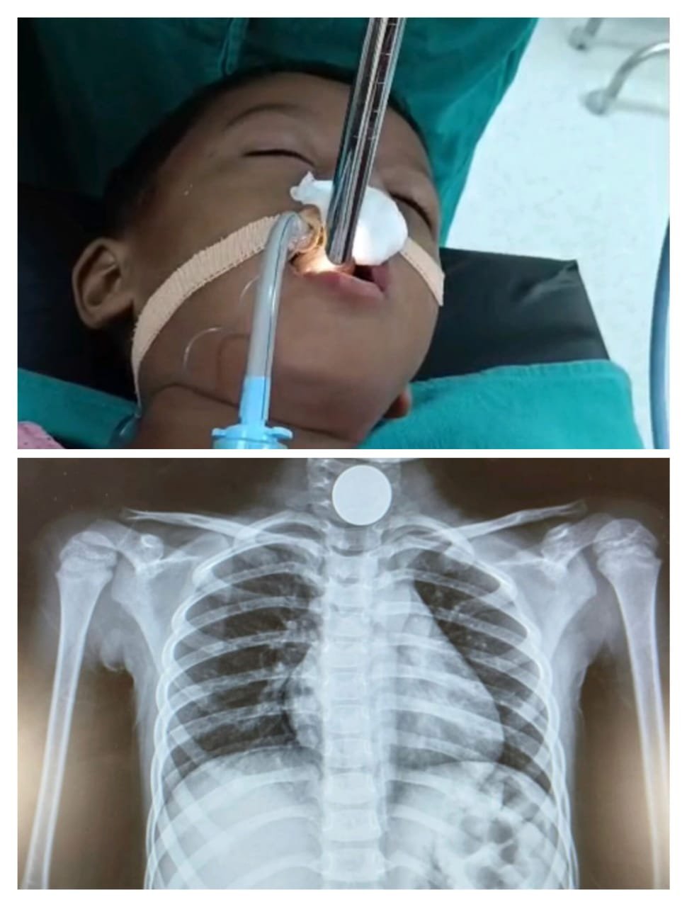 06 वर्षीय नन्ही बच्ची के लिये वरदान बना “SJAS सुपरस्पेशियलिटी हॉस्पिटल” 15 दिन में तीसरी बार बचायी नन्ही बच्ची की जान….