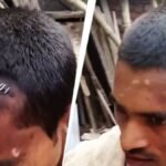 नवादा में सिर फटने पर डॉक्टर ने टांकों की जगह स्टेपलर पिन लगाया…